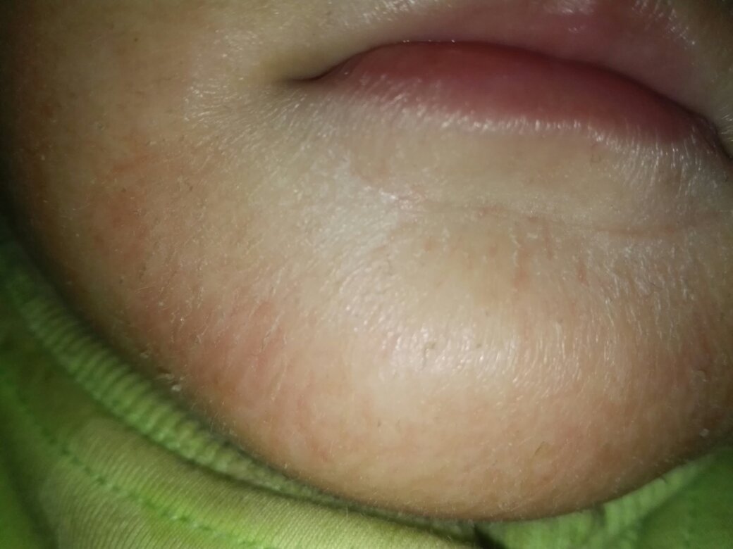 我家宝宝8个月了,大家帮我看看这到底怎么了,就下巴那一片,有点暴皮