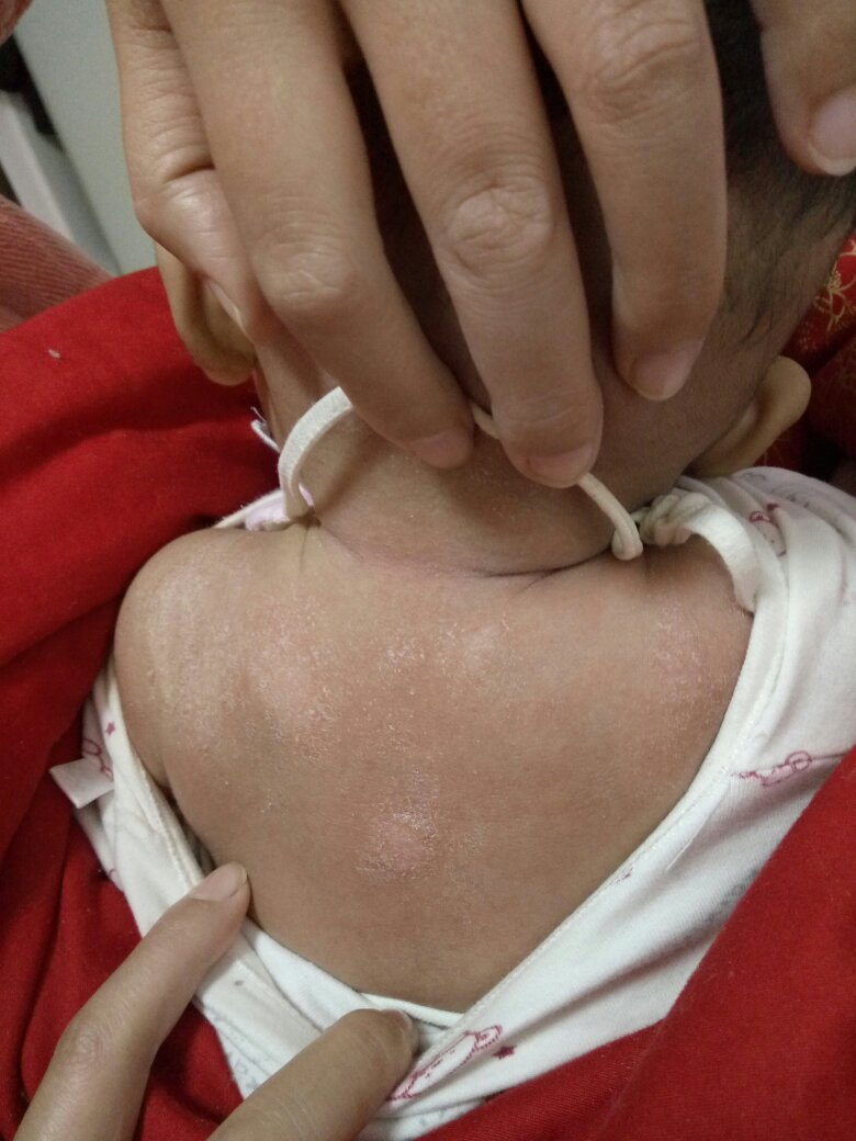 儿童汗斑早期症状图片图片