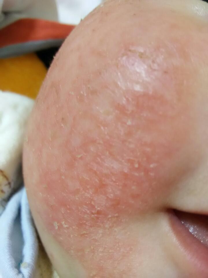 婴儿脸部长湿疹图片图片