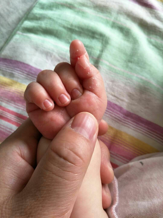 宝宝手指肚,手掌,脚指肚蜕皮怎么办呀?