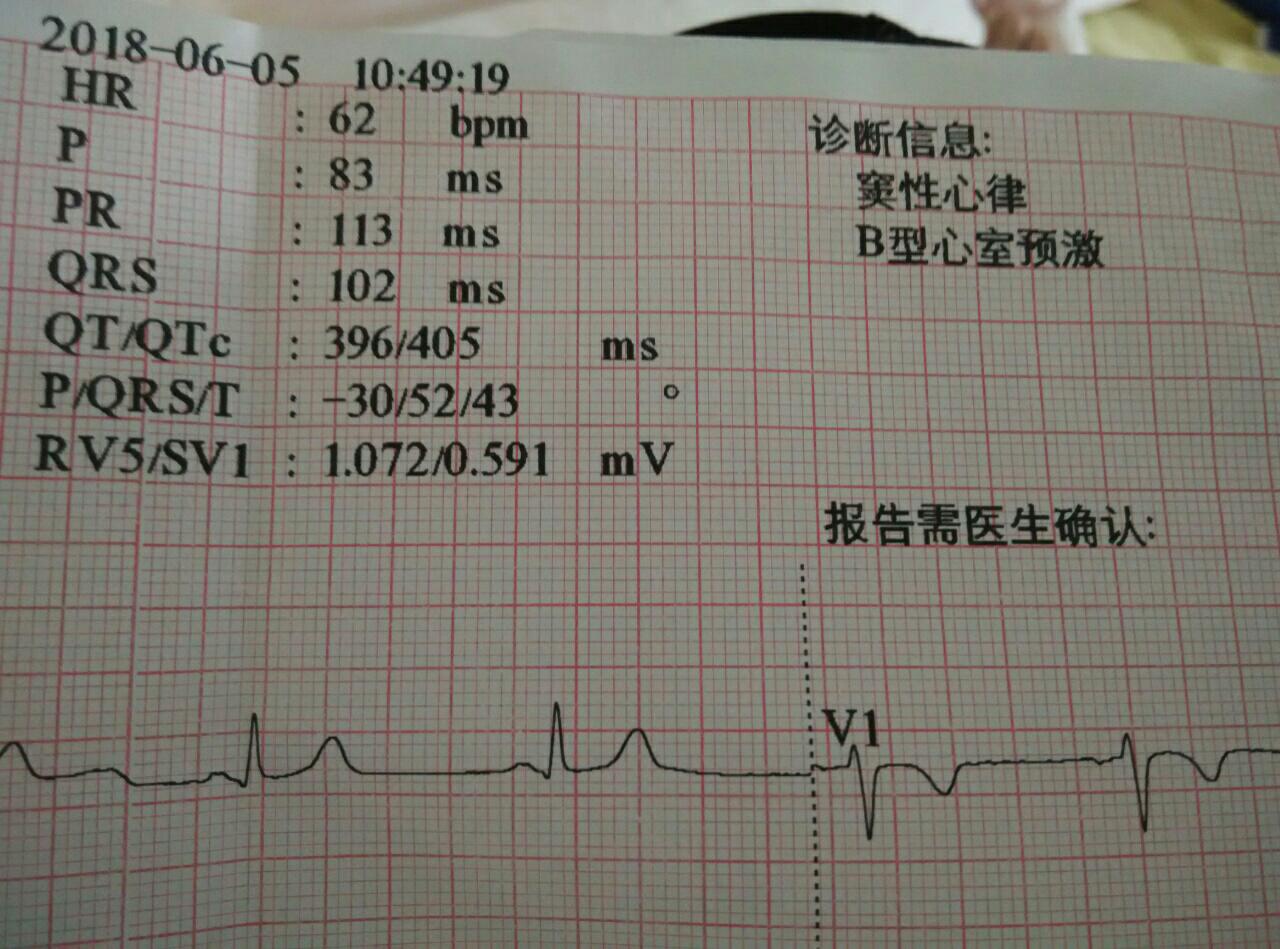 心室预激b型图片