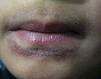 男孩 十一岁嘴上这样已经四五个月了 吃药看医生都