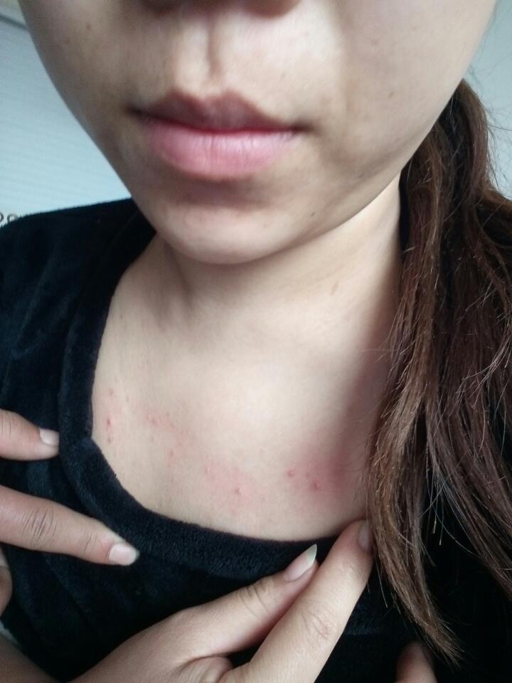 怀孕24周了,胸前长了一大堆痘痘,有的还有小白尖,和粉刺差不多,这是