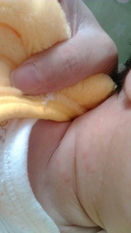 宝宝脸上的湿疹用丹皮酚擦好了,可是脖子上的好像越来越严重怎么回事