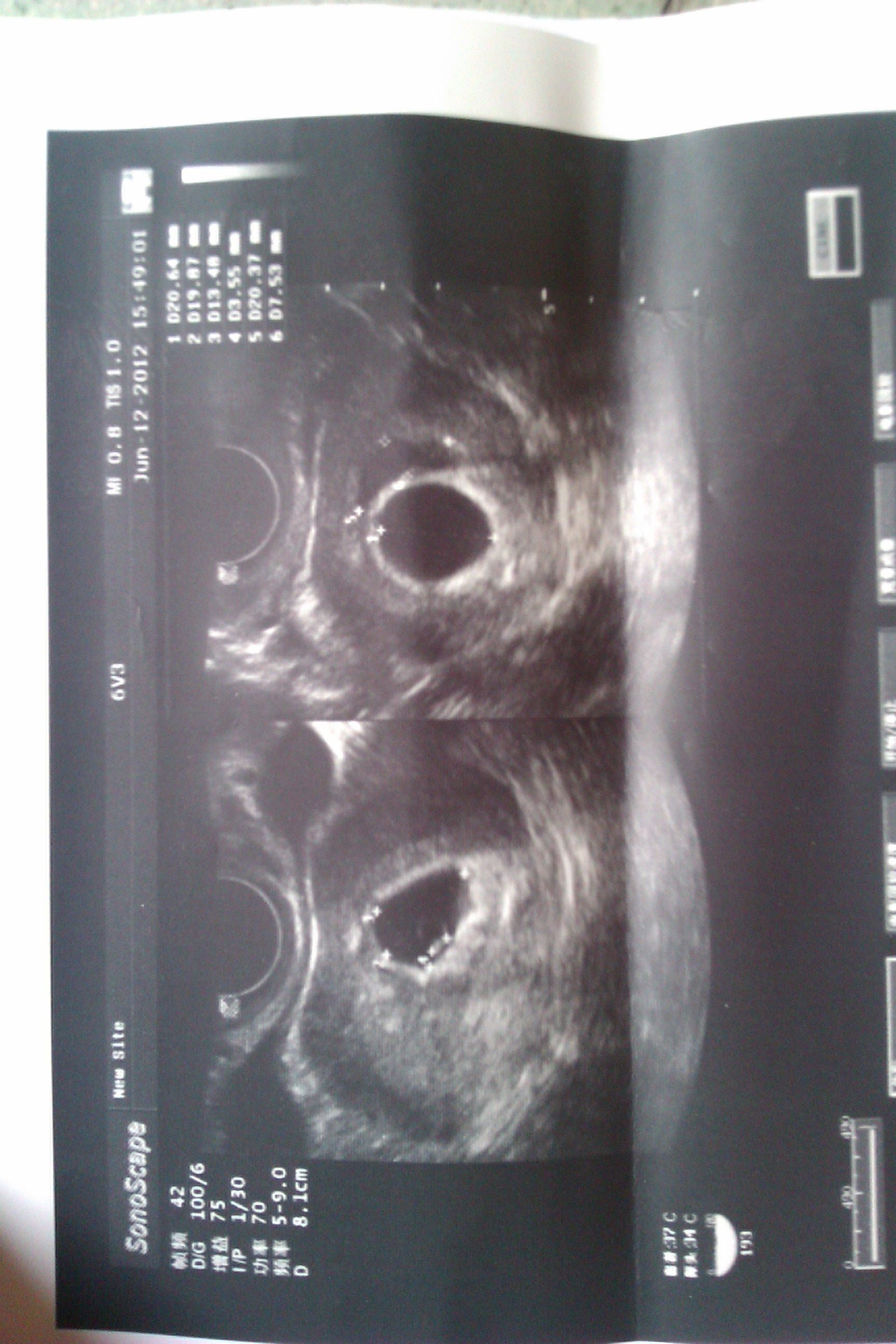 B超检查孕囊为1.7~2.3.但是3天后药流出来的白色孕囊有蛋黄大小椭圆形，有5厘米直径，这是30几天怀孕的么 - 百度宝宝知道