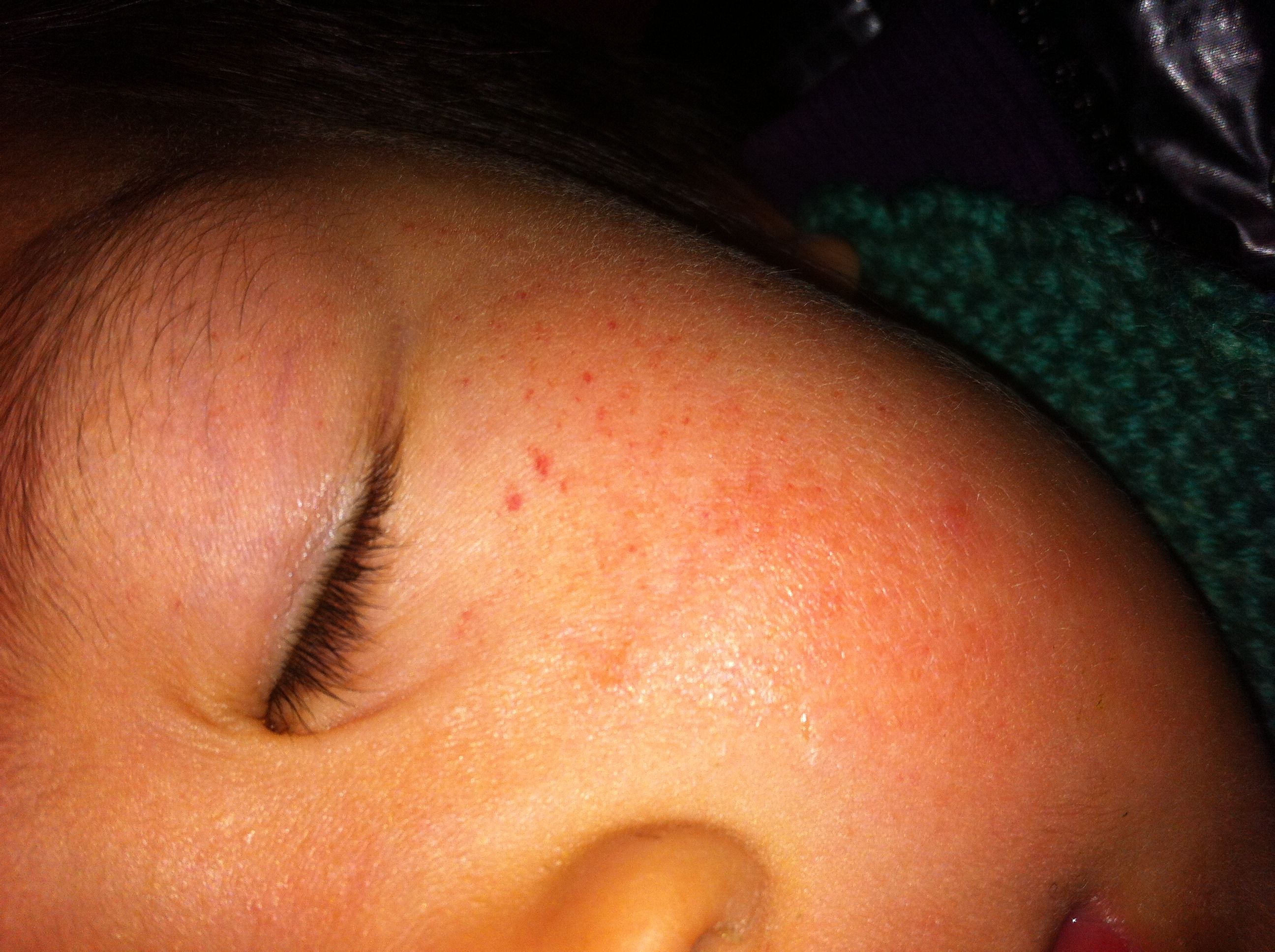 3岁小宝宝感冒,脸上起红疹,是什么原因
