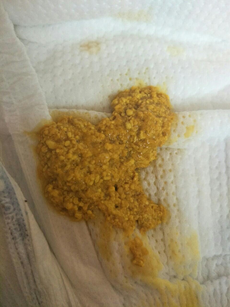 喝母乳宝宝消化不良有哪些症状