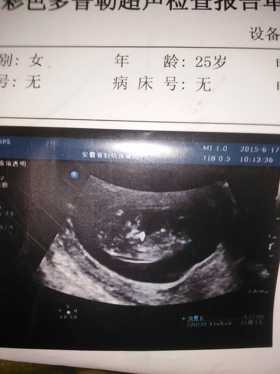 问答 问答首页  满意回答 您好,一般正常的孕囊是椭圆形的,根据您提供