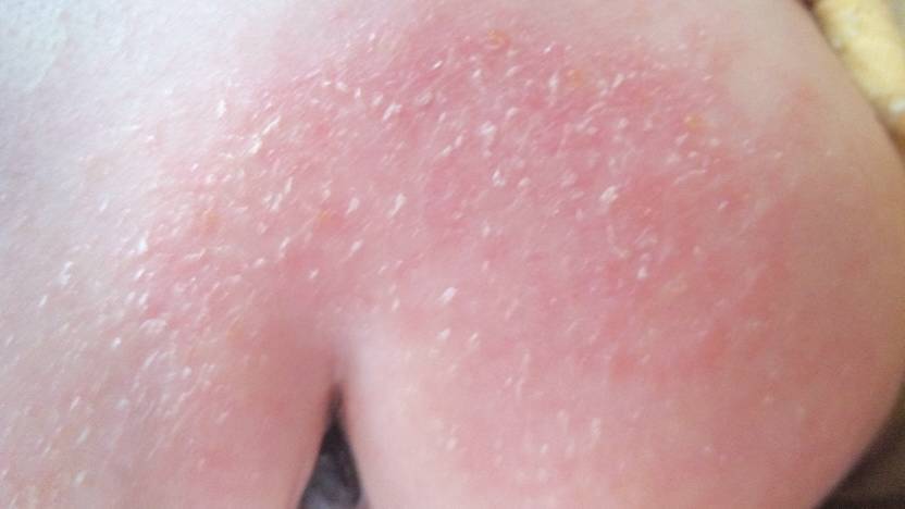 宝宝脸上起湿疹,现在又红又起皮,该怎么办?