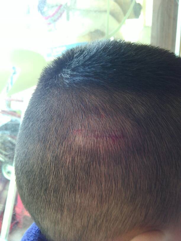 三岁小孩头被撞出一个包还出了一点血,怎么办啊?