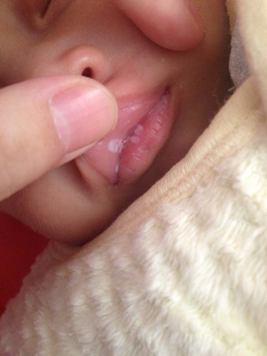 我儿子是母乳喂养 今天嘴唇突然长了一些白色的东西 这些到底是什么