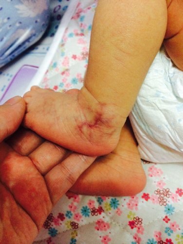 我家宝宝出生至今左脚外踝骨处有明显血管颜色痕迹,宝宝一哭时就会比