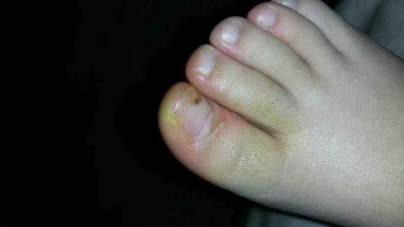 其他回答 你好,引起脚痛原因较多,临床上主要有跟腱周围炎;跟骨骨刺