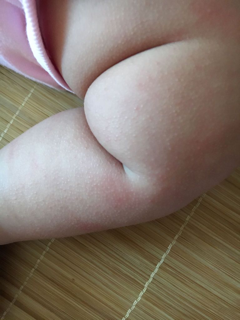 宝宝四肢都有这些小疙瘩,请问是什么呢?