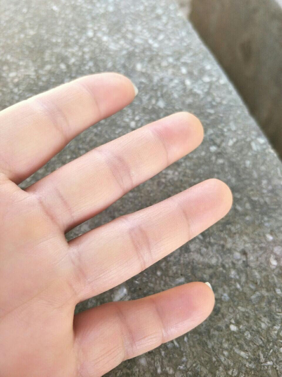 各位亲爱的孕妈,我现在怀孕将近5个月,左手手指发麻和有点肿胀,这种