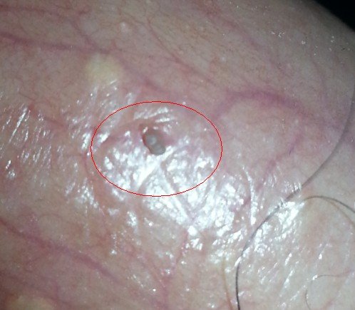 阴囊上起了个小肉阄、脖子上、腋下、乳头边上各有一个、脖子上的已经有五六年了，阴囊上原来还有一个被我