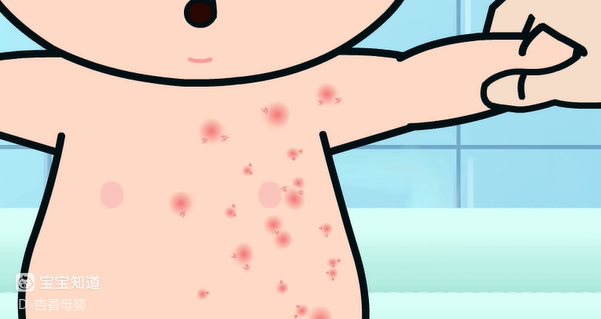 宝宝常见病系列病痱子