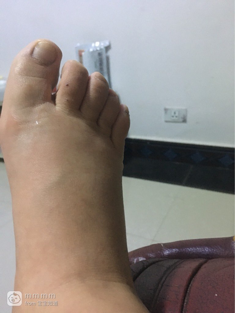 今天晚上发现脚肿了