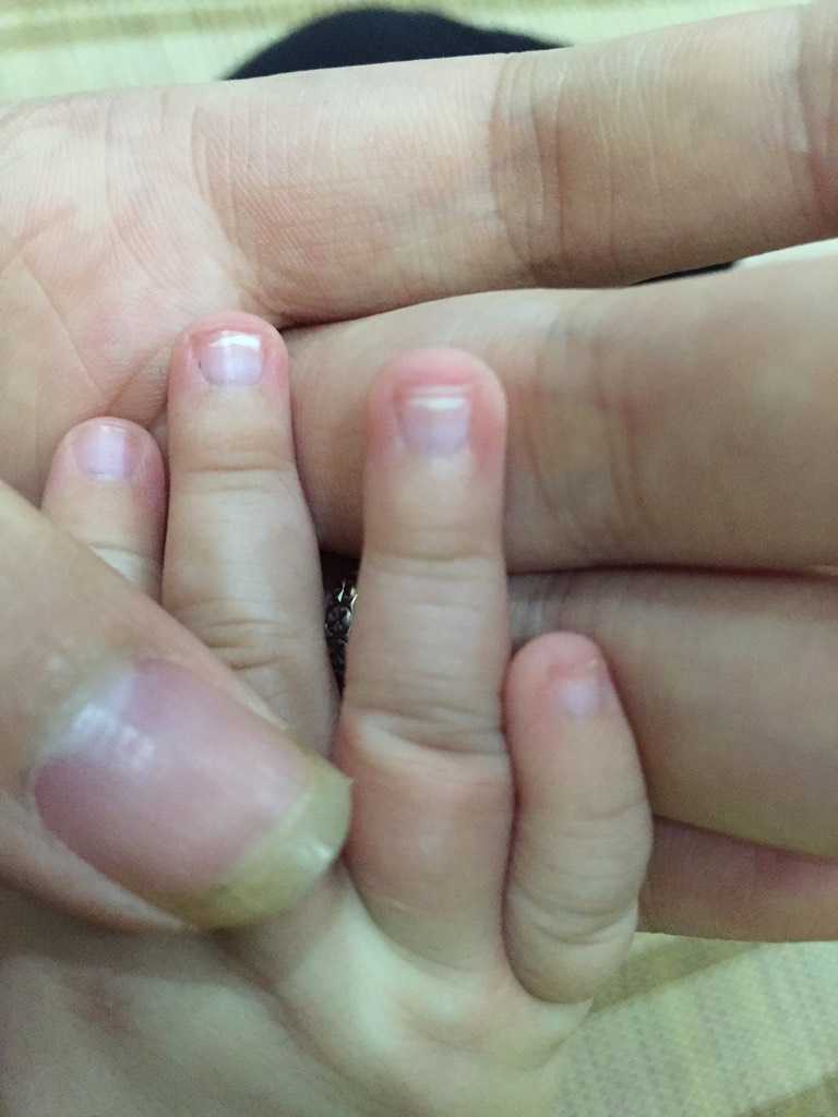 四个月半宝宝指甲里有白点是怎么回事?