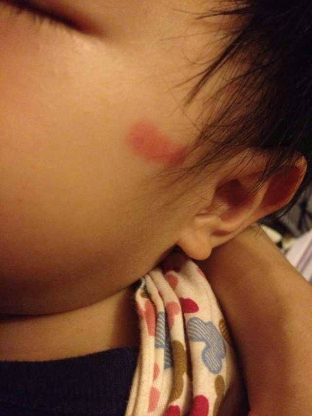 请问1岁大宝宝面部手部出现1cm右左(有圆形有长形)的红斑是什么来?