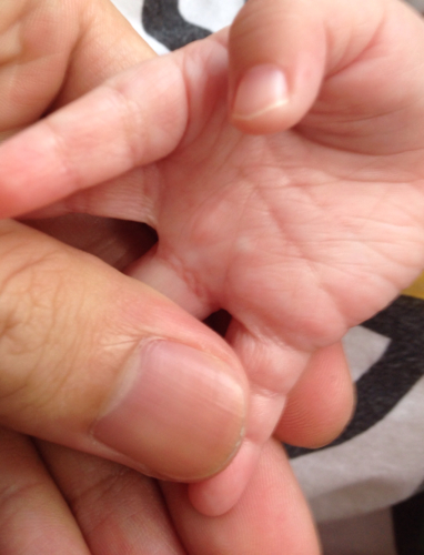 宝宝5个月,今天发现右手掌无名指处有一粒硬邦邦的东西,感觉像骨头