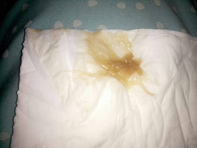 08-01 06:04     为您推荐: 其他回答 这样的情况情况不排除,阴道炎症