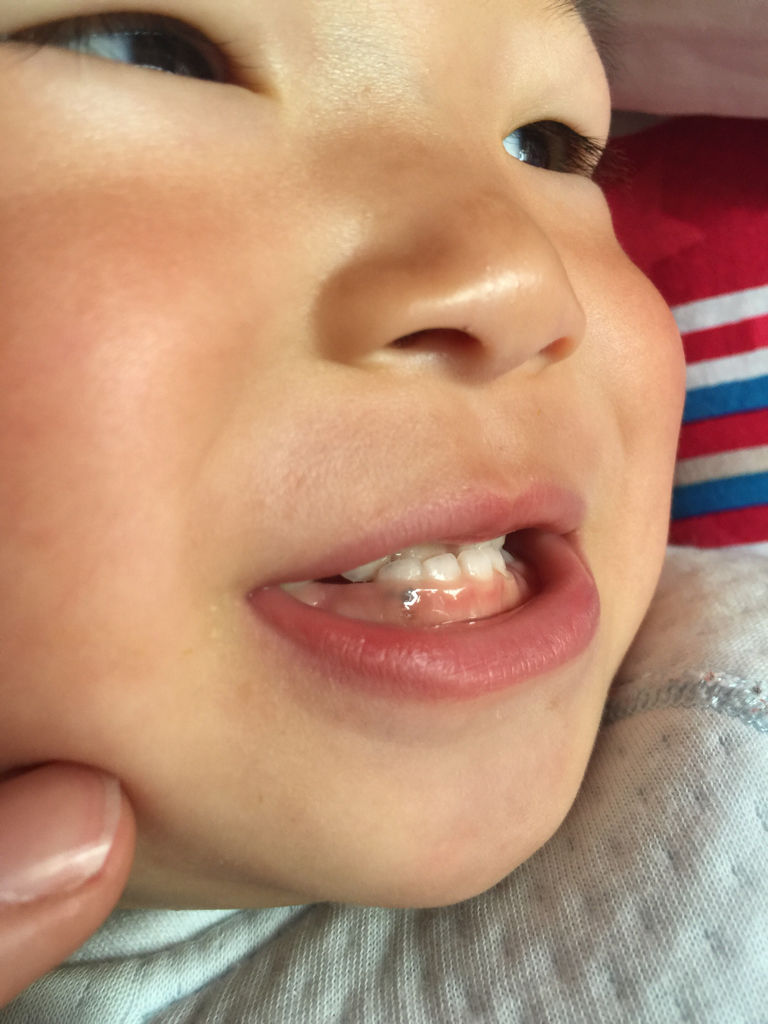 求鉴定,宝宝牙龈上黑了一块 之前以为是瘀血,可是一个礼拜过去了好像