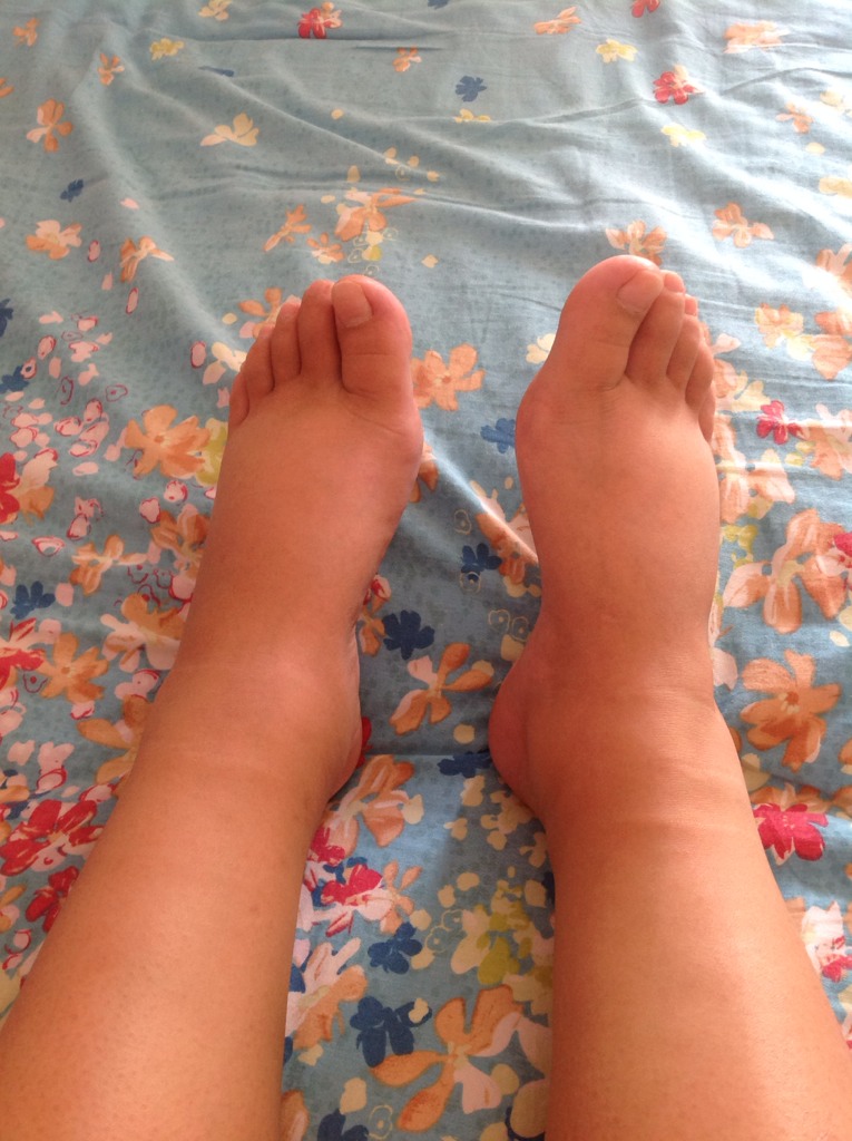 自从六号开始我的脚和腿浮肿的特别严重现在我是六个月了 但浮肿的太