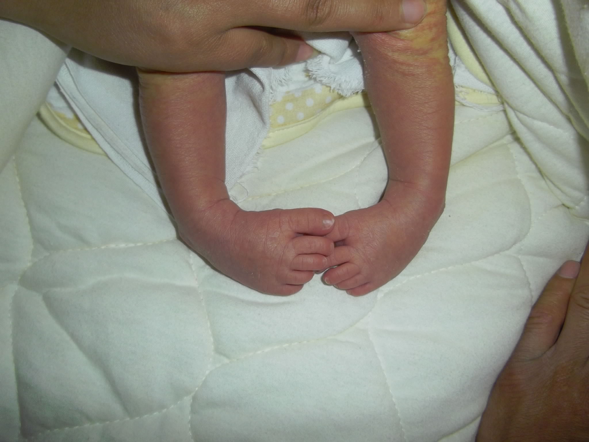 刚出生的婴儿足内翻图片