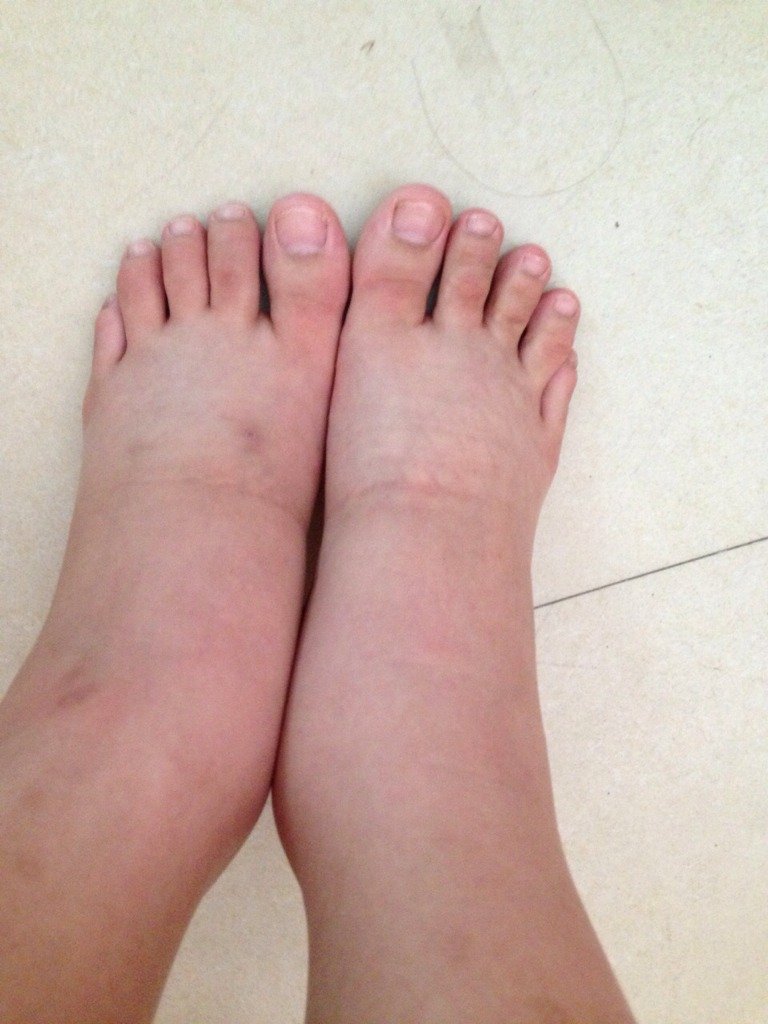 差不多要六个月了 现在脚就开始水肿的厉害 有什么直接办法能缓解水肿