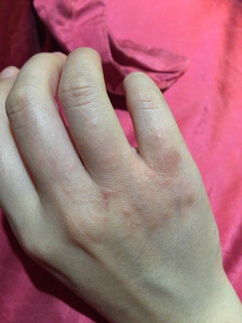 手上过敏像是湿疹,很痒的,不敢搽药,怎么办
