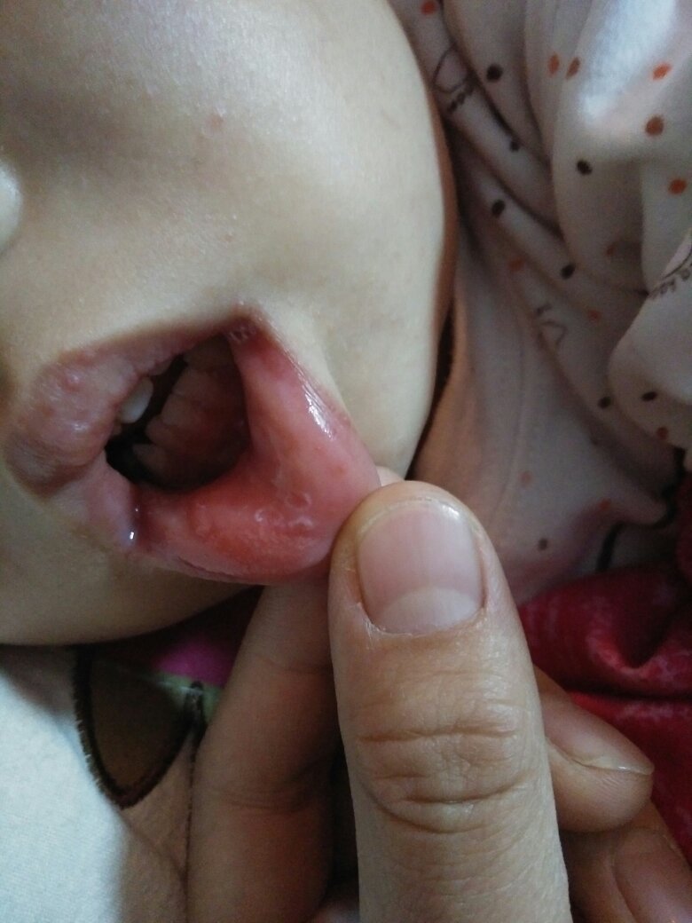 宝宝高烧后,口腔里面长了十几个溃疡,而且手背和小手臂都起了一些水泡