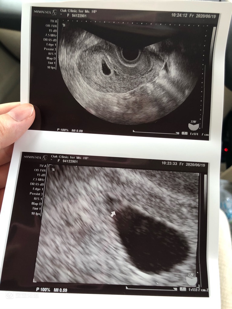 怀孕6周女孩孕囊图图片