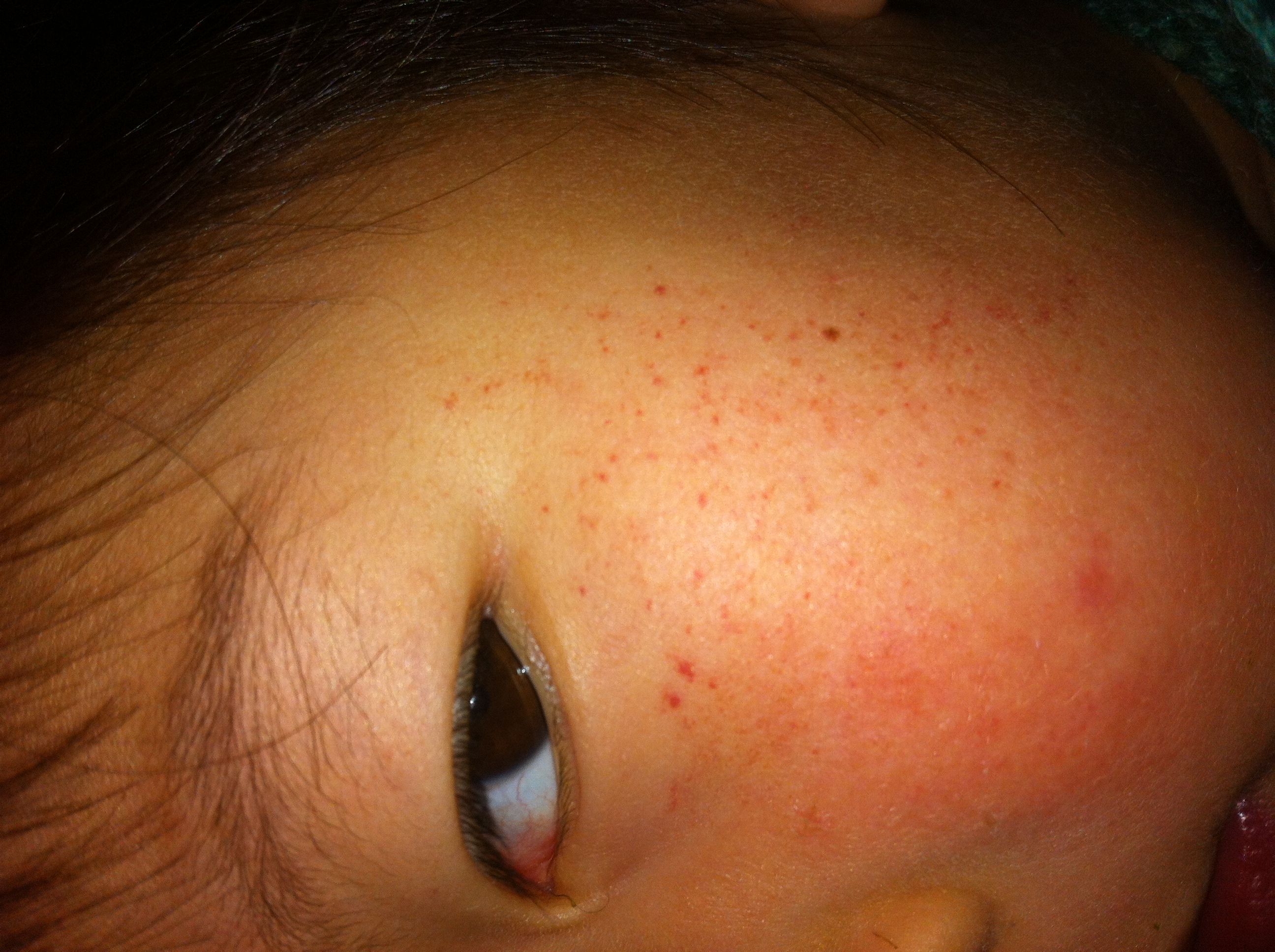 3岁小宝宝感冒,脸上起红疹,是什么原因