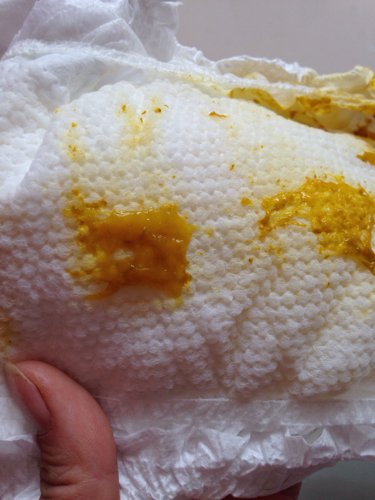 您好,宝宝两个多月,大便突然有大块黏液,但是大便次数正常,也没有奶瓣