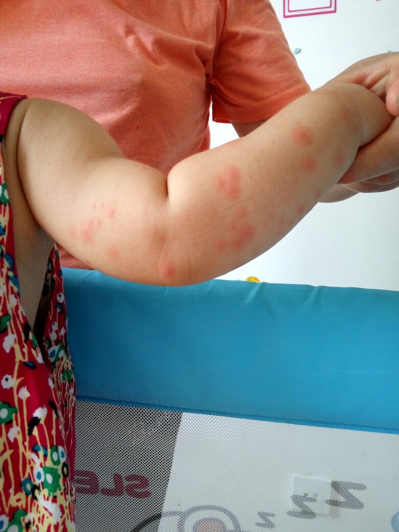 宝宝胳膊起了好多红疙瘩,是湿疹还是幼儿急疹?