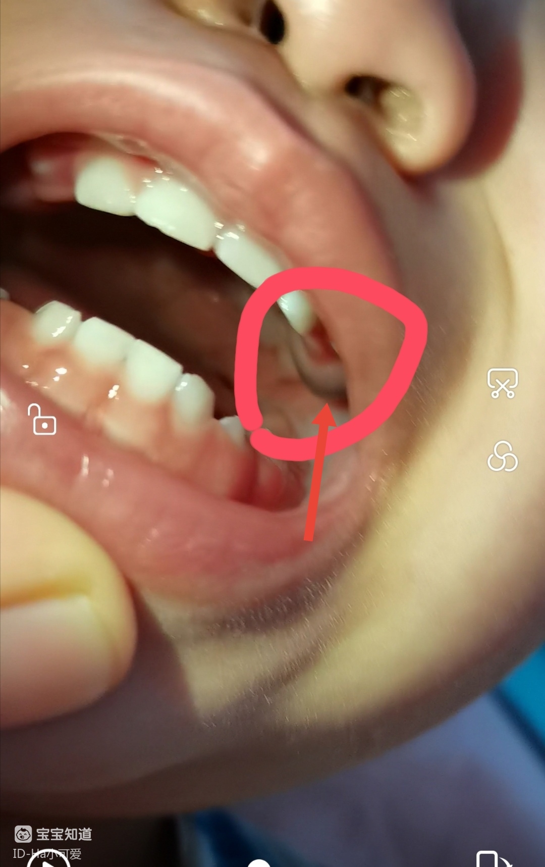 宝宝长牙牙龈鼓包图片