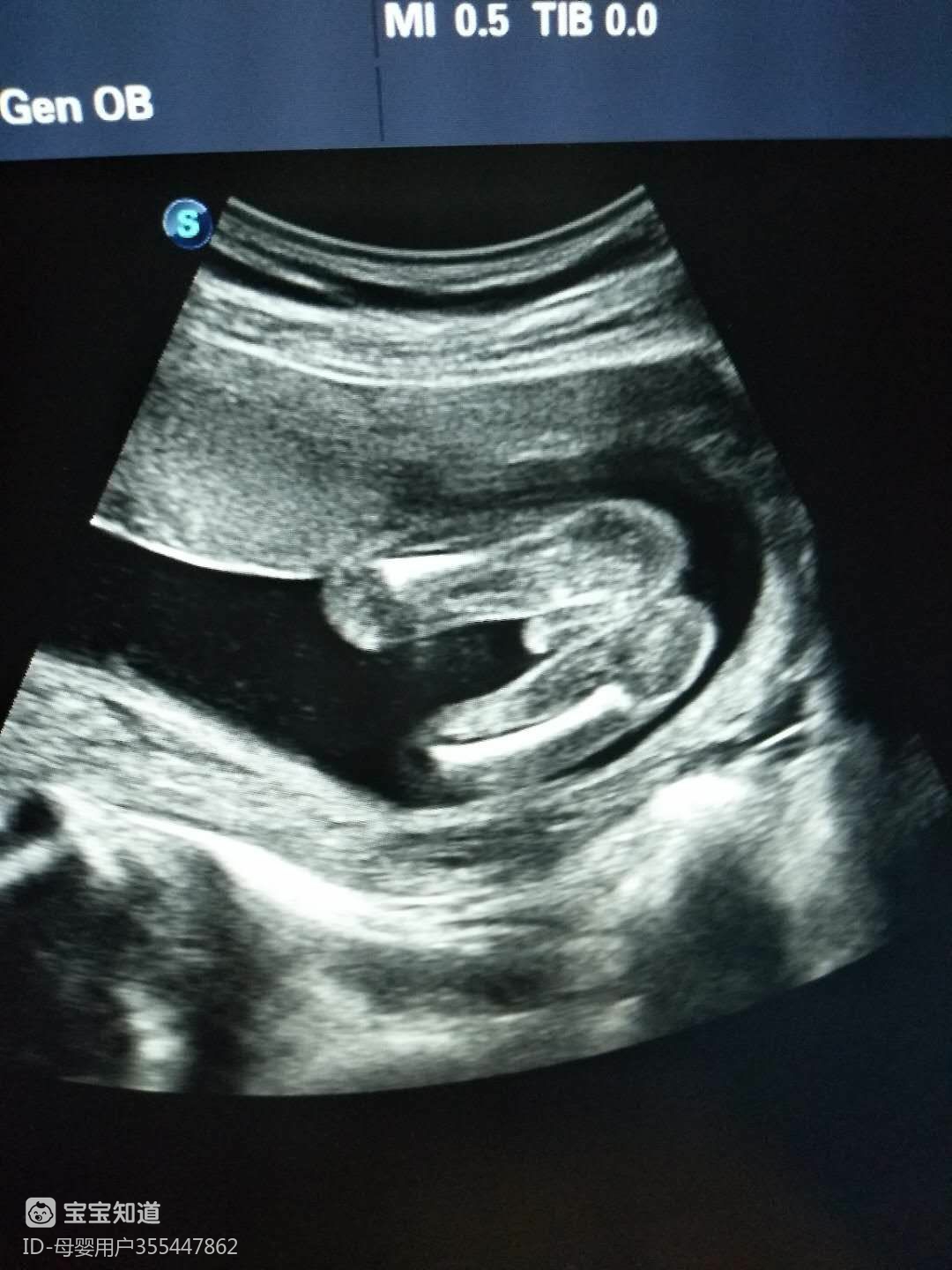 怀孕19周胎儿彩超图片