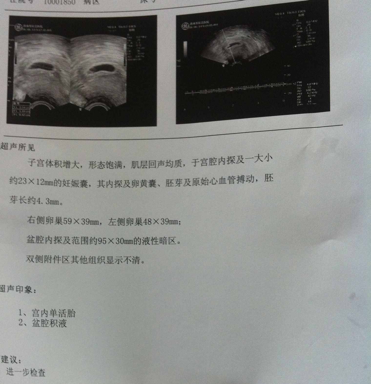 怀孕50天孕囊23mm*12mm,可探及卵黄囊,胚芽及原始心血管搏动,胚芽4.