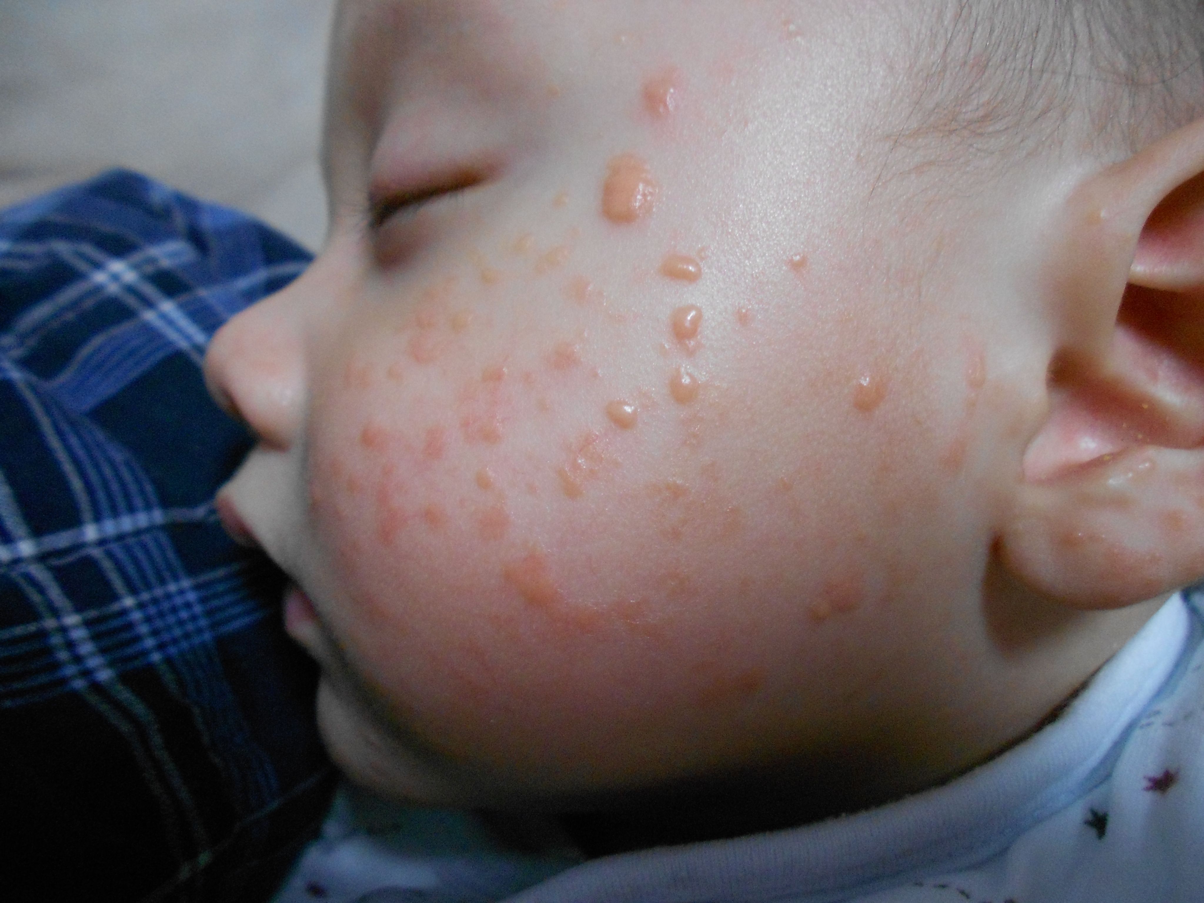 七个月宝宝过敏图,宝宝过敏症状及图片,七个月宝宝起疹子图片_大山谷图库