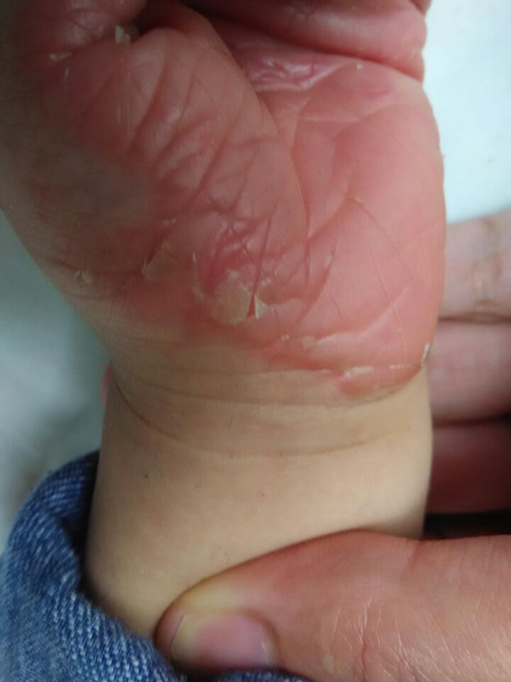 3岁宝宝手脚蜕皮非常严重,无法控制,怎么办?