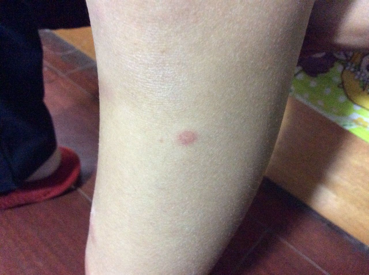 婴儿腿上起的红疙瘩，周围红，中间是硬的白点，这是过敏还是什么虫子咬的？谢谢 - 百度宝宝知道