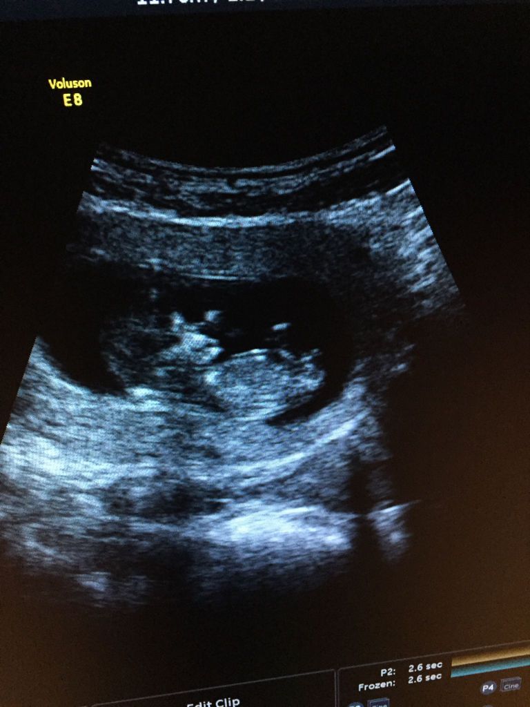 今天怀孕十一周 nt 宝宝这个照片怎么这么奇怪