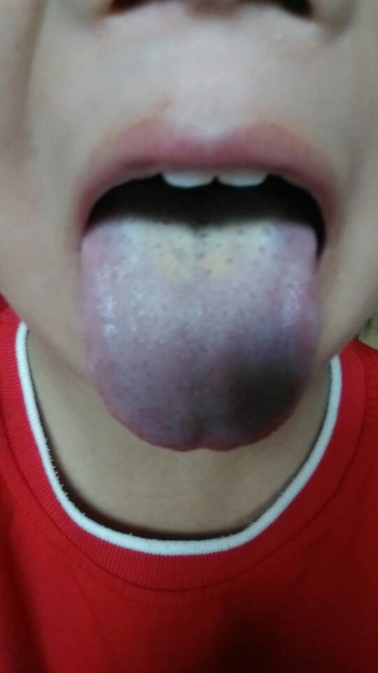 舌头缺锌什么症状图片图片