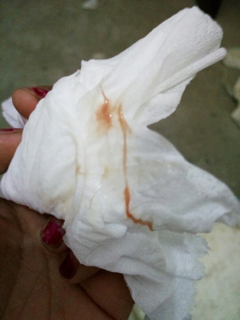 白带里面有血丝,昨天还少一点,今天就多了,请问这是月经吗,以前月经来