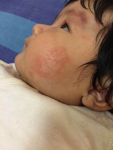 出来的,初期用郁美净代替擦脸油,保持干燥,如果不管用,就买婴儿湿疹膏