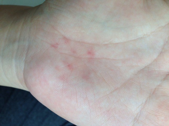 早上发现手掌有红点,怎么回事啊?