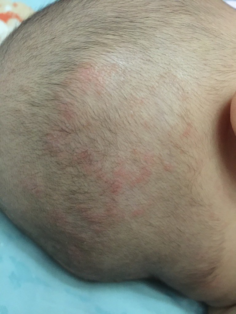 我儿子头上长的这是湿疹吗?急急急 - 百度宝宝知道