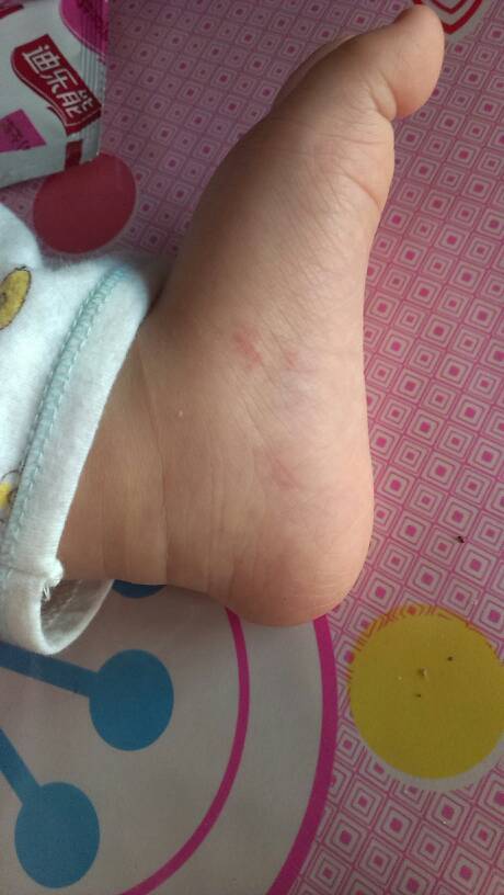 帮帮忙看看我家宝宝脚上怎么了,谢谢 琉璃暮雪    2015-04-28 18:12