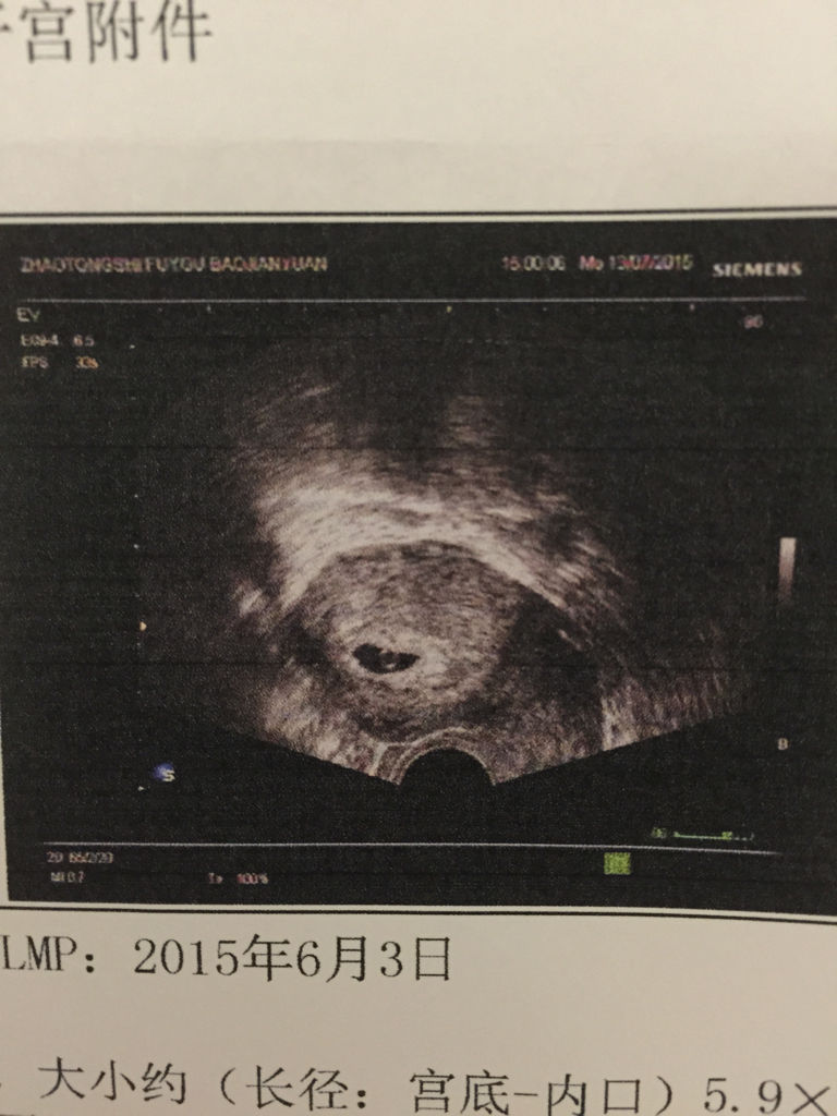 怀孕2周孕囊大小图片图片